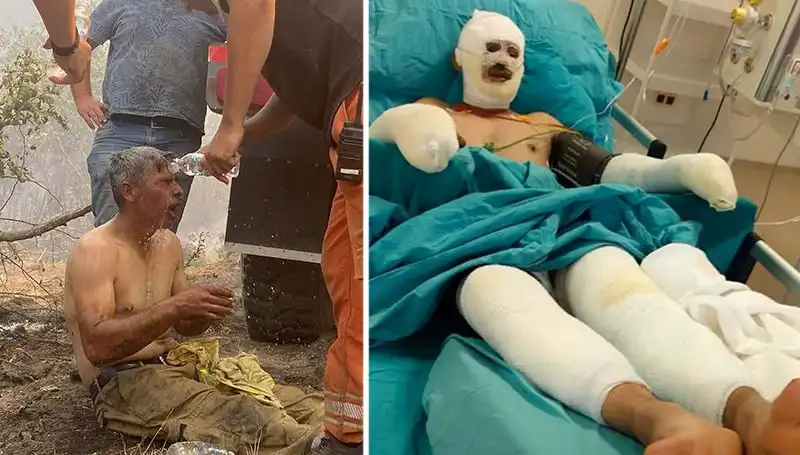 Ormanda Yangından Sonra 'Yanıyorum' Diyen İşçinin Mücadelesi Devam Ediyor