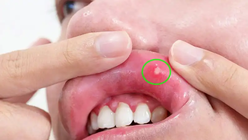 Kanserin Gizli Uyarı İşareti: Dili Alınmak Zorunda Kaldı