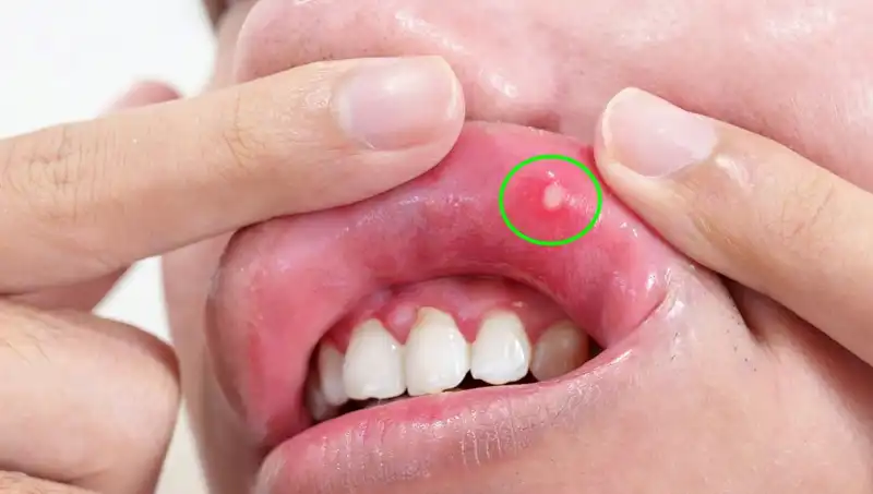 B Vitaminleri Eksikliği: Vücudunuzun Gizli Uyarı İşaretleri